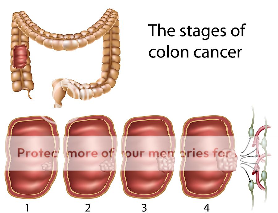 Stage 4 Colon Cancer Pictures, Images & Photos | Photobucket